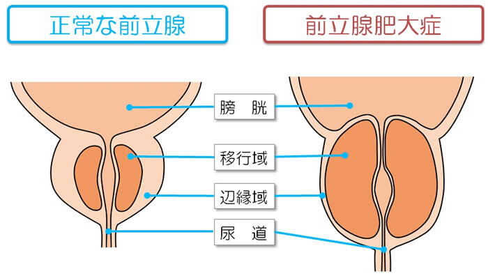 前立腺 