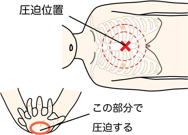 一刻も早い処置がいのちを救う 急変時の対応とaed 健康情報 利根中央病院