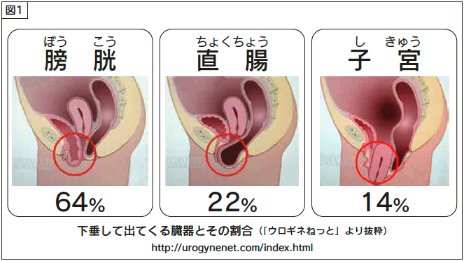 子宮脱 