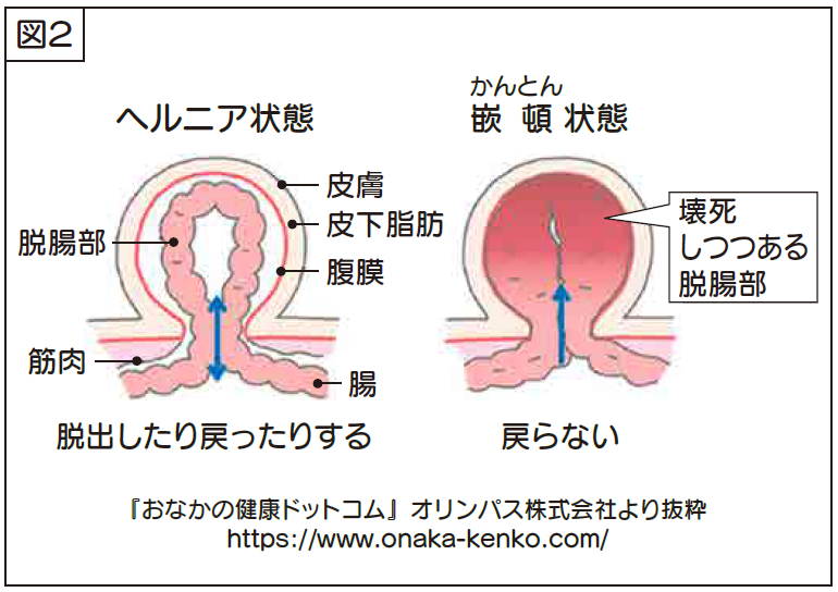 鼠径 ヘルニア 放置 すると