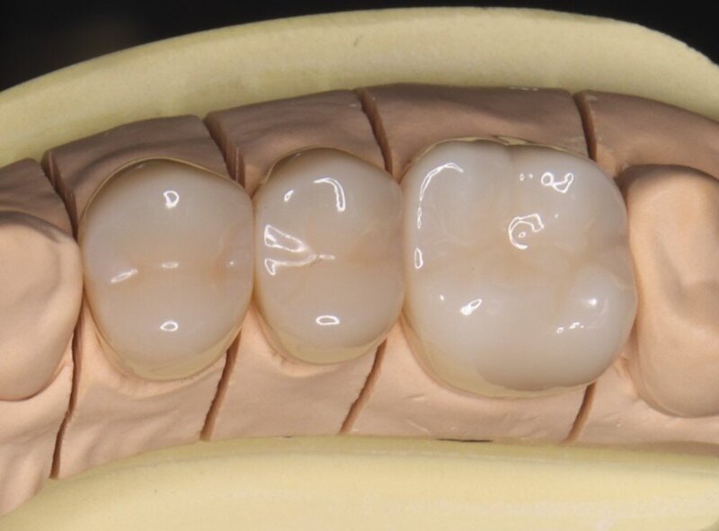 ジルコニア製の人工歯は耐久性・審美性に優れています。